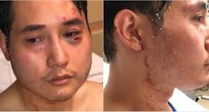 Injuries of Journalist Andy Ngo